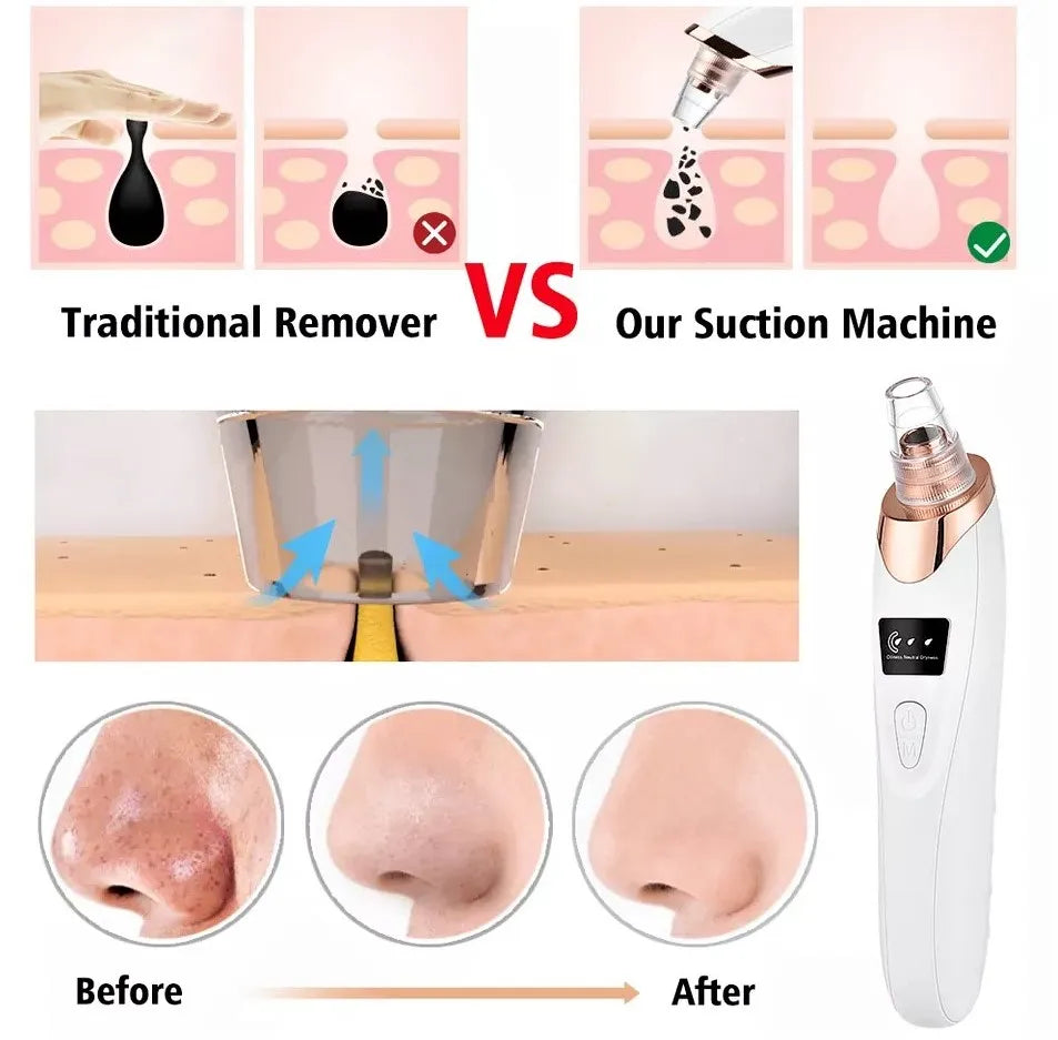 Electric Blackhead Remover – 4-in-1 Pore Cleaner & Facial Vacuum